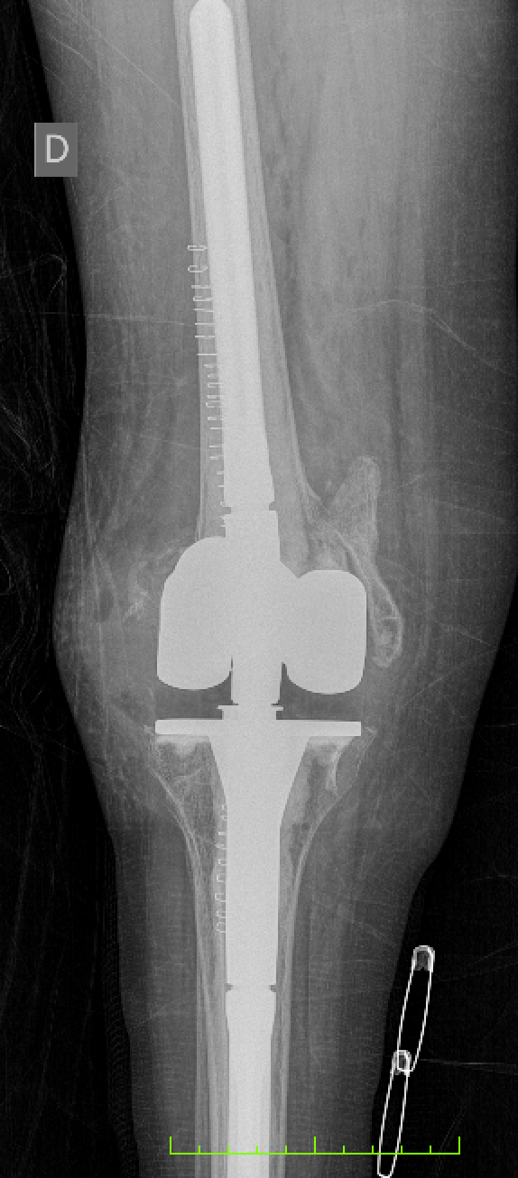 RPTG FRACTURE
